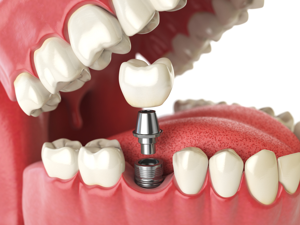 Single tooth implants Hamilton Township, NJ